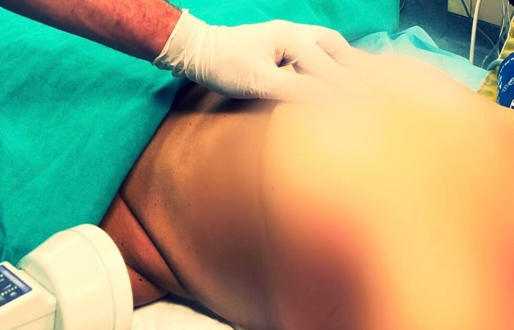 Βιοψία Φρουρού Λεμφαδένα