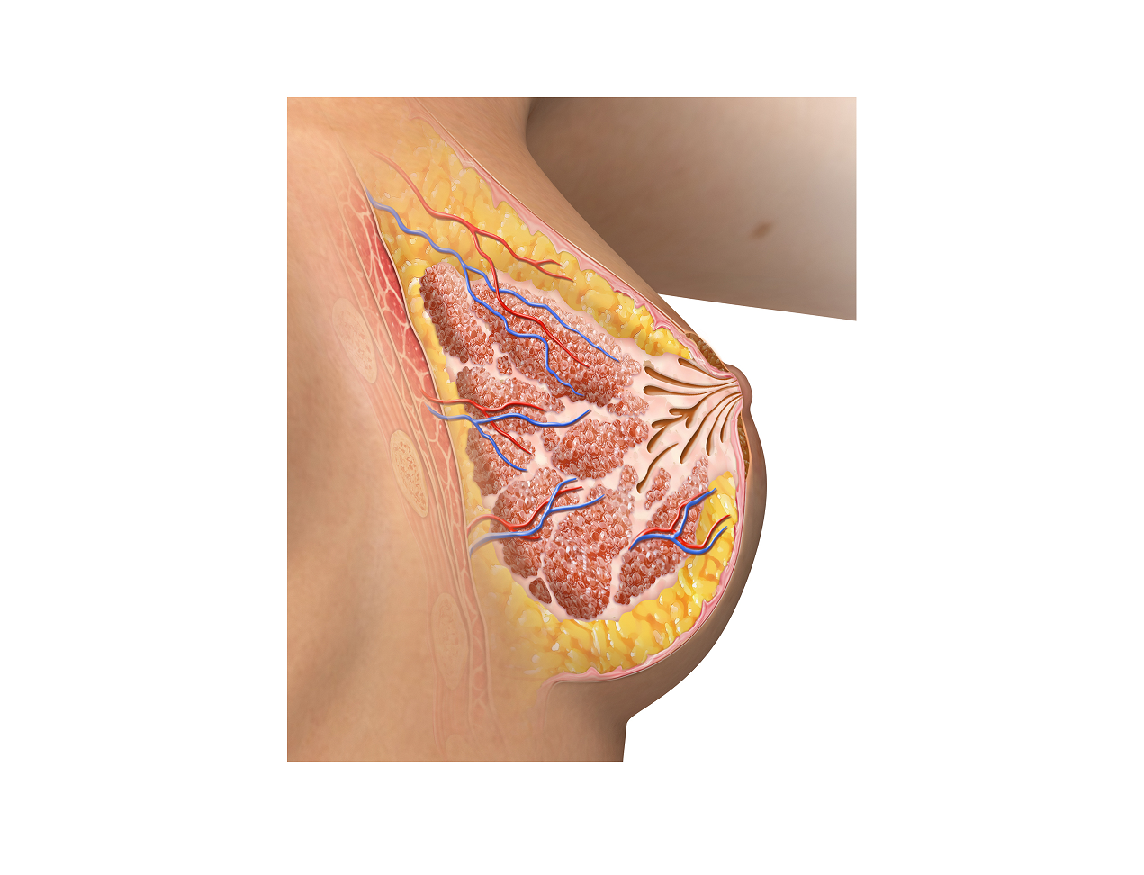 Πορεκτασία - Εκτασία Γαλακτοφόρων Πόρων